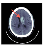 Unsupervised Acute Intracranial Hemorrhage Segmentation With Mixture Models